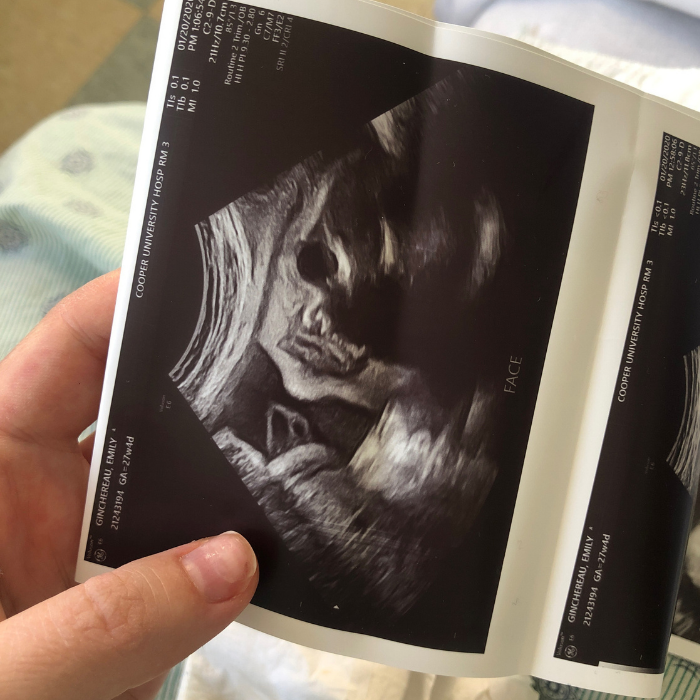 The Time Abortion Touched Our Family: Life Decisions After a Prenatal Diagnosis